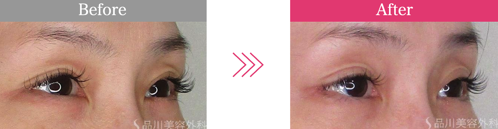 品川美容外科　スーパーナチュラル⽬尻切開法　症例写真　画像